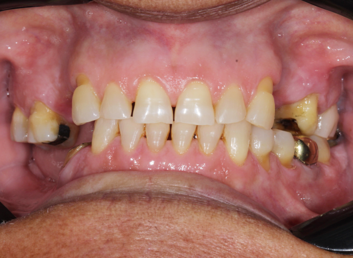 Implante Dentário Feira de Santana BA