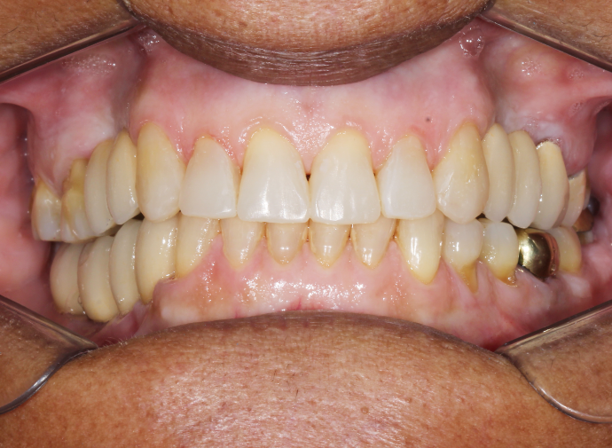 Implante Dentário Feira de Santana BA